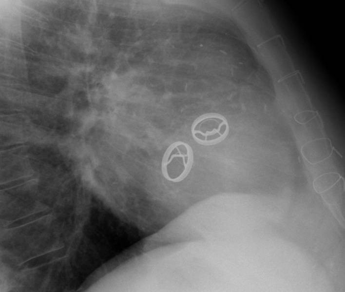 Kardiologie - Herzklappen-prothesen im Rntgenbild
