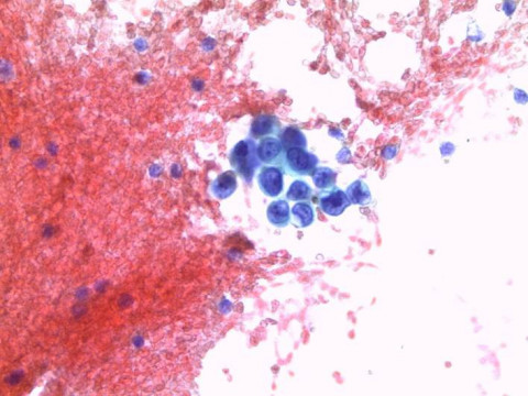 Pulmonales Adenokarzinom; Zytologie aus Pleurapunktat mit Zellen eines pulmonalen Adenokarzinoms: PAP-Färbung 40x