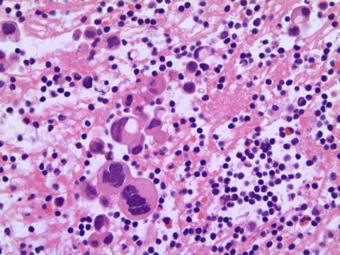 Pulmonales Adenokarzinom; Zytologie aus Pleurapunktat mit Zellen eines pulmonalen Adenokarzinoms: HE-Färbung 40x