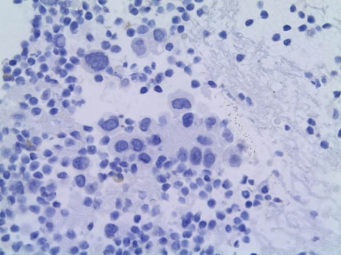 Pulmonales Adenokarzinom; Zytologie aus Pleurapunktat mit Zellen eines pulmonalen Adenokarzinoms: Calretinin-Markierung 40x (Immunhistochemie)