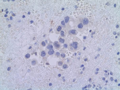 Pulmonales Adenokarzinom; Zytologie aus Pleurapunktat mit Zellen eines pulmonalen Adenokarzinoms: D2-40-Markierung 40x (Immunhistochemie)