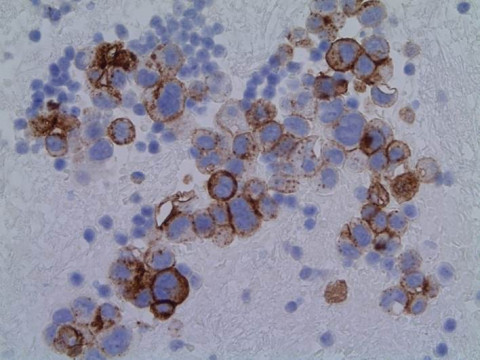 Pulmonales Adenokarzinom; Zytologie aus Pleurapunktat mit Zellen eines pulmonalen Adenokarzinoms: EA-Markierung 40x (Immunhistochemie)
