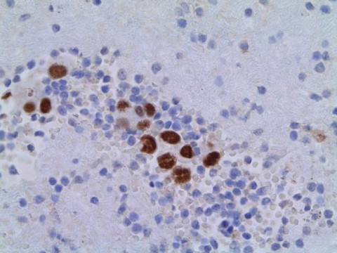 Pulmonales Adenokarzinom; Zytologie aus Pleurapunktat mit Zellen eines pulmonalen Adenokarzinoms: TTF1-Markierung 40x (Immunhistochemie)