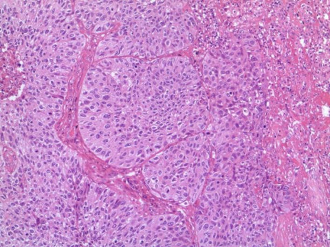 Pulmonales Plattenepithelkarzinom; Histologie aus Lungenresektat mit Verbänden eines Plattenepithelkarzinoms: HE-Färbung 10x