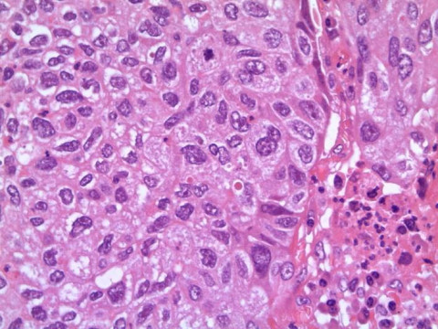Pulmonales Plattenepithelkarzinom; Histologie aus Lungenresektat mit Verbänden eines Plattenepithelkarzinoms: HE-Färbung 40x