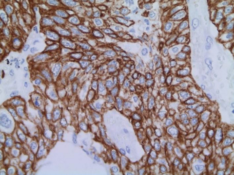 Pulmonales Plattenepithelkarzinom; Histologie aus Lungenresektat mit Verbänden eines Plattenepithelkarzinoms: CK5-Markierung 40x  (Immunhistochemie)