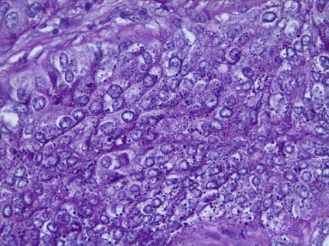 Pulmonales Plattenepithelkarzinom; Histologie aus Lungenresektat mit Verbänden eines Plattenepithelkarzinoms: PAS-Färbung 40x