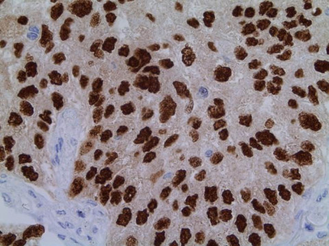 Pulmonales Plattenepithelkarzinom; Histologie aus Lungenresektat mit Verbänden eines Plattenepithelkarzinoms: p63-Markierung 40x  (Immunhistochemie)