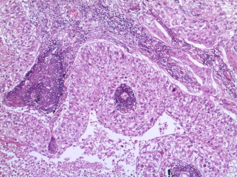 Pulmonales Plattenepithelkarzinom; Histologie aus Lungenresektat mit Verbänden eines Plattenepithelkarzinoms: EHE-Markierung 10x  (Immunhistochemie)