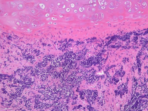 Kleinzelliges Bronchialkarzinom; Histologie aus Bronchialbiopsat mit Verbänden eines kleinzelligen Bronchialkarzinoms: HE-Färbung 10x 