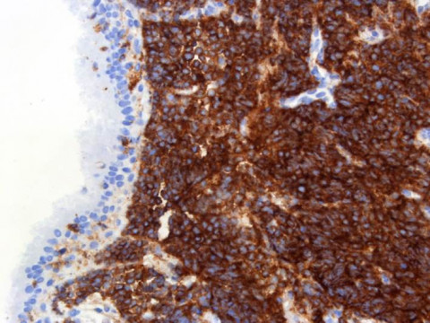 Kleinzelliges Bronchialkarzinom; Histologie aus Bronchialbiopsat mit Verbänden eines kleinzelligen Bronchialkarzinoms: CD56-Markierung 20x (Immunhistochemie)