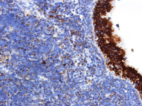 Kleinzelliges Bronchialkarzinom; Histologie aus Bronchialbiopsat mit Verbänden eines kleinzelligen Bronchialkarzinoms: CK18-Markierung 20x (Immunhistochemie)