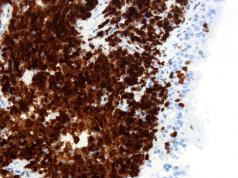 Kleinzelliges Bronchialkarzinom; Histologie aus Bronchialbiopsat mit Verbänden eines kleinzelligen Bronchialkarzinoms: Ki67-Markierung 20x (Immunhistochemie)