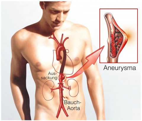 Aneurysma - Angiologie